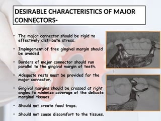 MAJOR CONNECTORS IN REMOVABLE PARTIAL DENTURE | PPTX