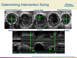 Ivus Normal Range 6.How & What To Measure!! IVUS ( 5 min).pptx