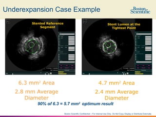 6.How & What To Measure!! IVUS ( 5 min).pptx