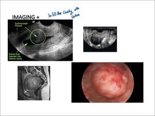 6.UTERINE FIBROIDs with all types of fibroid | PDF