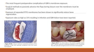 Comprehensive Guide to Intraoral Bone Grafting Techniques and Healing ...