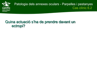 Patologia dels annexes oculars - Parpelles i pestanyes
Patologia dels annexes oculars                    Cas clínic 6.2
Cas clínic 6.2



    Quina actuació s’ha de prendre davant un
       ectropi?
 