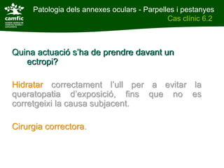 Patologia dels annexes oculars - Parpelles i pestanyes
Patologia dels annexes oculars                Cas clínic 6.2
Cas clínic 6.2



Quina actuació s’ha de prendre davant un
   ectropi?

Hidratar correctament l’ull per a evitar la
queratopatia d’exposició, fins que no es
corretgeixi la causa subjacent.

Cirurgia correctora.
 