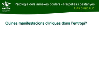 Patologia dels annexes oculars - Parpelles i pestanyes
Patologia dels annexes oculars                    Cas clínic 6.2
Cas clínic 6.2



    Quines manifestacions clíniques dóna l’entropi?
 