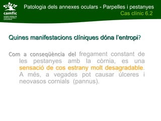Patologia dels annexes oculars - Parpelles i pestanyes
Patologia dels annexes oculars                Cas clínic 6.2
Cas clínic 6.2



Quines manifestacions clíniques dóna l’entropi?

Com a conseqüència del fregament constant de
   les pestanyes amb la còrnia, es una
   sensació de cos estrany molt desagradable.
   A més, a vegades pot causar úlceres i
   neovasos cornials (pannus).
 