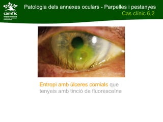 Patologia dels annexes oculars - Parpelles i pestanyes
                                        Cas clínic 6.2




      Entropi amb úlceres cornials que
      tenyeis amb tinció de fluoresceïna
 