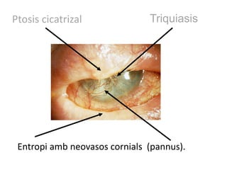 Ptosis cicatrizal              Triquiasis




 Entropi amb neovasos cornials (pannus).
 