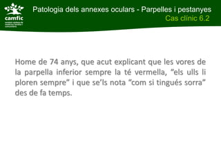 Patologia dels annexes oculars - Parpelles i pestanyes
Patologia dels annexes oculars                Cas clínic 6.2
Cas clínic 6.2




Home de 74 anys, que acut explicant que les vores de
la parpella inferior sempre la té vermella, “els ulls li
ploren sempre” i que se’ls nota “com si tingués sorra”
des de fa temps.
 
