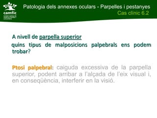 Patologia dels annexes oculars - Parpelles i pestanyes
Patologia dels annexes oculars                Cas clínic 6.2
Cas clínic 6.2



 A nivell de parpella superior
 quins tipus de malposicions palpebrals ens podem
 trobar?

 Ptosi palpebral: caiguda excessiva de la parpella
 superior, podent arribar a l’alçada de l’eix visual i,
 en conseqüència, interferir en la visió.
 