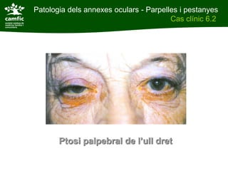 Patologia dels annexes oculars - Parpelles i pestanyes
                                        Cas clínic 6.2




       Ptosi palpebral de l’ull dret
 