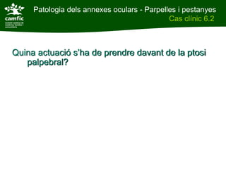 Patologia dels annexes oculars - Parpelles i pestanyes
Patologia dels annexes oculars                    Cas clínic 6.2
Cas clínic 6.2



    Quina actuació s’ha de prendre davant de la ptosi
       palpebral?
 