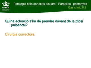 Patologia dels annexes oculars - Parpelles i pestanyes
Patologia dels annexes oculars                Cas clínic 6.2
Cas clínic 6.2



Quina actuació s’ha de prendre davant de la ptosi
   palpebral?

Cirurgia correctora.
 
