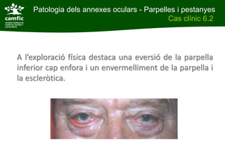 Patologia dels annexes oculars - Parpelles i pestanyes
Patologia dels annexes oculars                Cas clínic 6.2
Cas clínic 6.2




 A l’exploració física destaca una eversió de la parpella
 inferior cap enfora i un envermelliment de la parpella i
 la escleròtica.
 