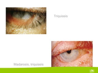 Triquiasis




Madarosis, triquiasis
 