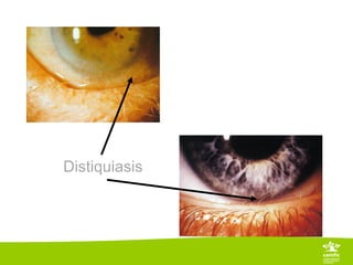 Distiquiasis
 