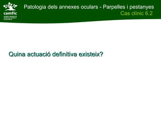 Patologia dels annexes oculars - Parpelles i pestanyes
Patologia dels annexes oculars                    Cas clínic 6.2
Cas clínic 6.2




    Quina actuació definitiva existeix?
 