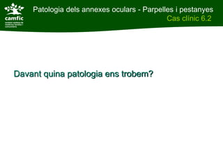 Patologia dels annexes oculars - Parpelles i pestanyes
Patologia dels annexes oculars                  Cas clínic 6.2
Cas clínic 6.2




 Davant quina patologia ens trobem?
 