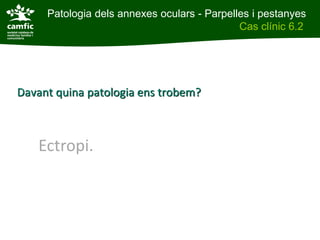 Patologia dels annexes oculars - Parpelles i pestanyes
Patologia dels annexes oculars                Cas clínic 6.2
Cas clínic 6.2




Davant quina patologia ens trobem?



     Ectropi.
 