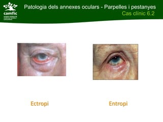 Patologia dels annexes oculars - Parpelles i pestanyes
Patologia dels annexes oculars                Cas clínic 6.2
Cas clínic 6.2




            Ectropi                     Entropi
 