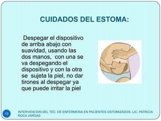 CUIDADOS DEL ESTOMA:

       Despegar el dispositivo
      de arriba abajo con
      suavidad, usando las
      dos manos, con una se
      va despegando el
      dispositivo y con la otra
      se sujeta la piel, no dar
      tirones al despegar ya
      que puede irritar la piel


     INTERVENCION DEL TEC. DE ENFERMERIA EN PACIENTES OSTOMIZADOS- LIC. PATRICIA
13
     ROCA VARGAS
 