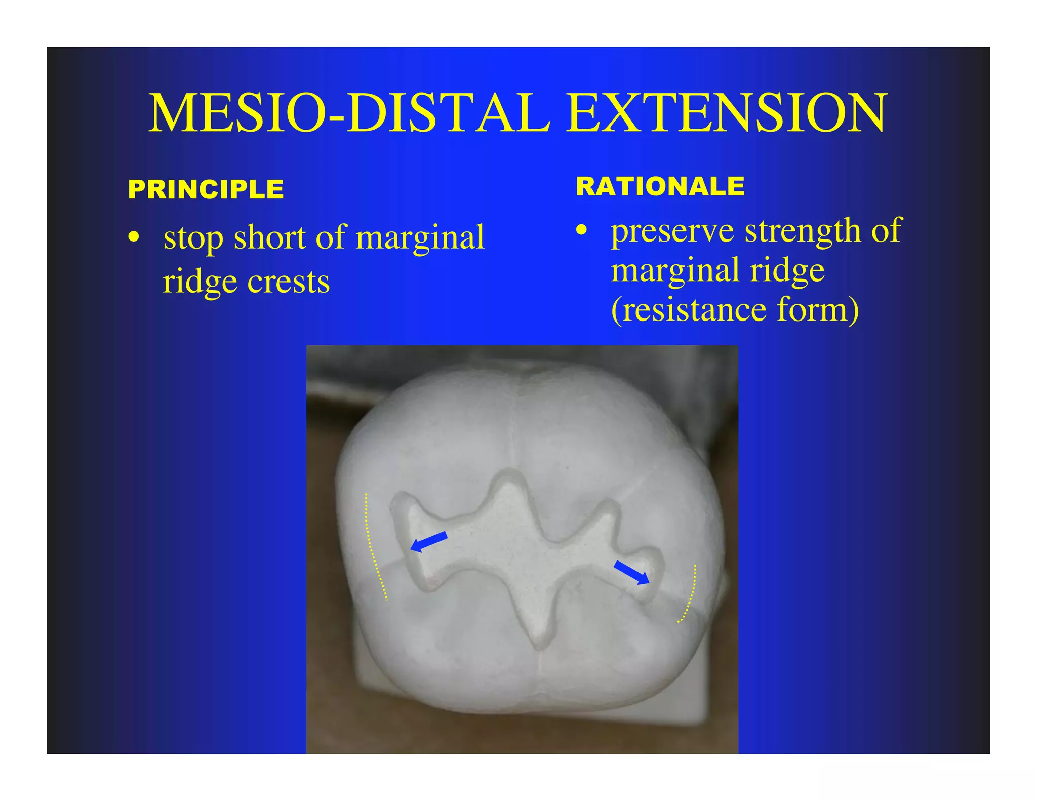 principles of tooth preparation (class one) | PDF