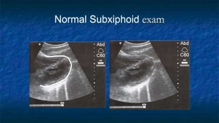Normal Subxiphoid exam
 