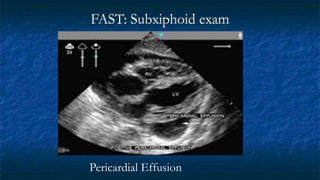 FAST: Subxiphoid exam
Pericardial Effusion
 