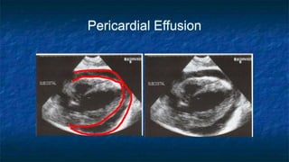 Pericardial Effusion
 
