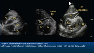 Types of pericardial effusions, subxiphoid cardiac view.
Left image: typical effusion, middle image: clotted effusion , right image : with cardiac tamponade
.
 