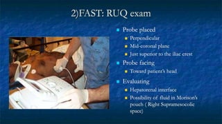 2)FAST: RUQ exam
 Probe placed
 Perpendicular
 Mid-coronal plane
 Just superior to the iliac crest
 Probe facing
 Toward patient’s head
 Evaluating
 Hepatorenal interface
 Possibility of fluid in Morison’s
pouch ( Right Supramesocolic
space)
 