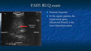 FAST: RUQ exam
 Normal Anatomy
 In the supine patient, the
hepatorenal space
(Morison’s Pouch) is the
most dependent space
Anterior
Posterior
Inferior
Superior
Morison’s
Pouch
 