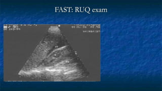 FAST: RUQ exam
L
K
FF
RS
D
 