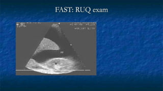 FAST: RUQ exam
L
K
FF
 