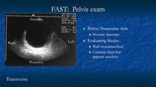 FAST: Pelvis exam
 Pelvis: Transverse Axis
 Normal Anatomy
 Evaluating Bladder
 Well cirucumscribed
 Contains fluid that
appears anechoic
Transverse
Anterior
Right Left
Posterior
 