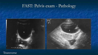 FAST: Pelvis exam - Pathology
Transverse
 