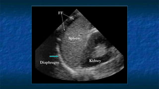 Kidney
Spleen
FF
Diaphragm
 