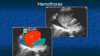 Hemothorax
KD
SP
FF
D
 