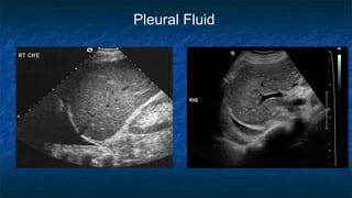 Pleural Fluid
 