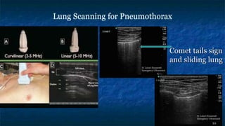 Lung Scanning for Pneumothorax
Comet tails sign
and sliding lung
 
