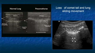 Loss of comet tail and lung
sliding movement
 
