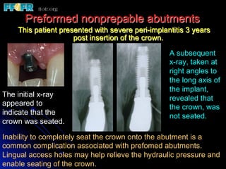 Preformed nonprepable abutments
    This patient presented with severe peri-implantitis 3 years
                     post insertion of the crown.

                                                  A subsequent
                                                  x-ray, taken at
                                                  right angles to
                                                  the long axis of
                                                  the implant,
The initial x-ray                                 revealed that
appeared to                                       the crown, was
indicate that the                                 not seated.
crown was seated.

Inability to completely seat the crown onto the abutment is a
common complication associated with prefomed abutments.
Lingual access holes may help relieve the hydraulic pressure and
enable seating of the crown.
 