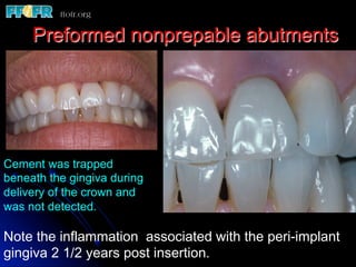 Preformed nonprepable abutments




Cement was trapped
beneath the gingiva during
delivery of the crown and
was not detected.

Note the inflammation associated with the peri-implant
gingiva 2 1/2 years post insertion.
 