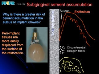 Subgingival cement accumulation
                                                   Sulcus    Epithelium




                                 Implant Surface
Why is there a greater risk of
cement accumulation in the
sulcus of implant crowns?


Peri-implant
tissues are
more easily
displaced from
                                                       Circumferential
the surface of
                                                       collagen fibers
the restoration.

                                                    Bone
 