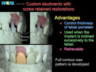 Custom abutments with
 screw retained restorations

                 Advantages
                    v    Control thickness
                          of labial porcelain
                    v    Used when the
Waxing                    implant is inclined
sleeve                    excessively to the
                          labial.
                    v    Retrievable

                  Full contour wax
                  pattern is developed
 