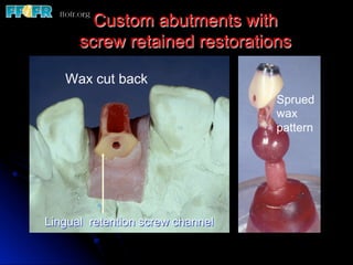 Custom abutments with
      screw retained restorations

   Wax cut back
                                  Sprued
                                  wax
                                  pattern




Lingual retention screw channel
 