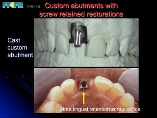 Custom abutments with
           screw retained restorations


Cast
custom
abutment




                 Note lingual retention screw orifice
 