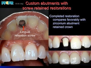 Custom abutments with
     screw retained restorations
                    Completed restoration
                      compares favorably with
                      zirconium abutment
                      retained crown
    Lingual
retention screw
 