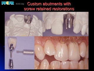 Custom abutments with
screw retained restorations
 
