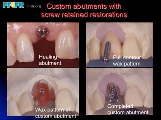 Custom abutments with
  screw retained restorations




 Healing                Full contour
 abutment               wax pattern




                      Completed
Wax pattern of        custom abutment
custom abutment
 