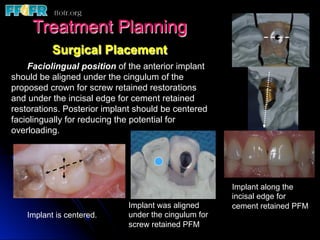 Treatment Planning
           Surgical Placement
    Faciolingual position of the anterior implant
should be aligned under the cingulum of the
proposed crown for screw retained restorations
and under the incisal edge for cement retained
restorations. Posterior implant should be centered
faciolingually for reducing the potential for
overloading.




                                                      Implant along the
                                                      incisal edge for
                             Implant was aligned      cement retained PFM
    Implant is centered.     under the cingulum for
                             screw retained PFM
 